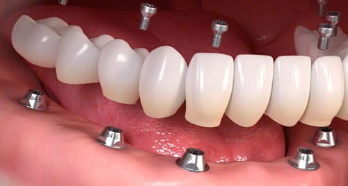 Dental Implants - Phoenix, AZ - Restore Your Smile