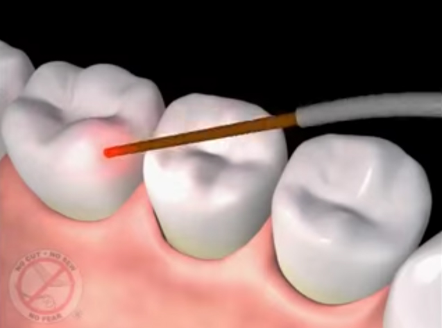 LANAP Laser Gum Surgery - Phoenix, AZ - Treat Gum Disease
