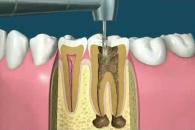 Root Canals - Phoenix, AZ - Remove Infected Teeth