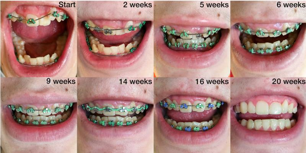 The results of Fastbraces